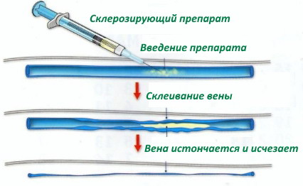 Флебит вены на руке после инъекции